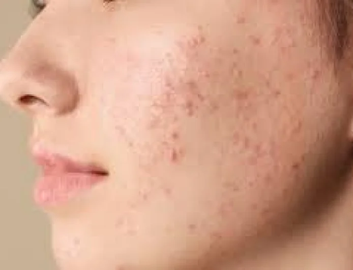 Paroxetine May Offer New Treatment Approach for Rosacea, Study Finds