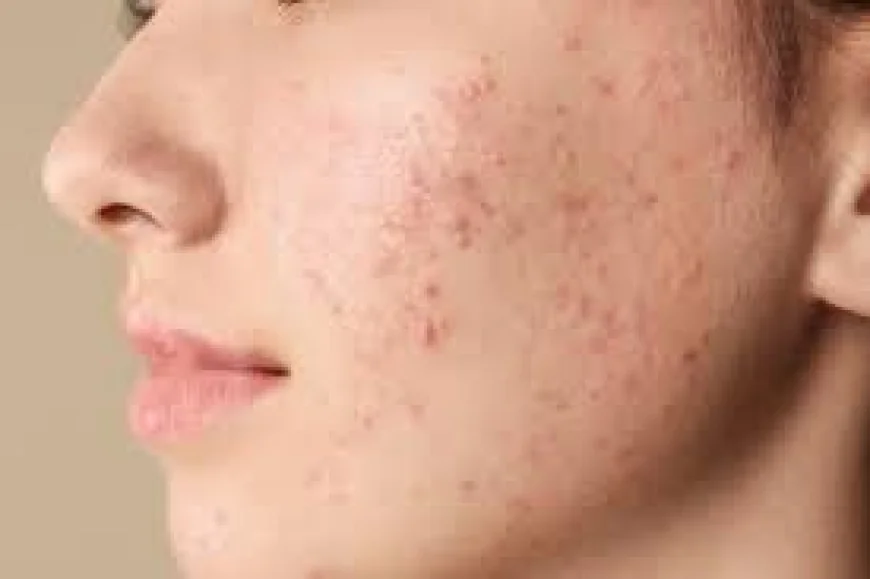 Paroxetine May Offer New Treatment Approach for Rosacea, Study Finds