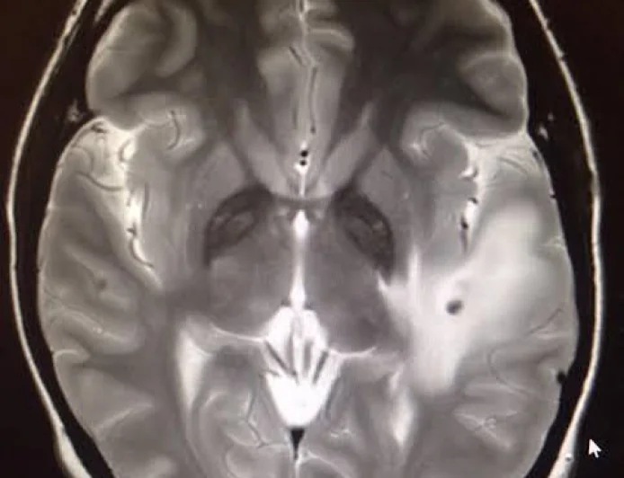 Woman Diagnosed With Metre-Long Tapeworm and 38 Brain Parasites Years After India Trip