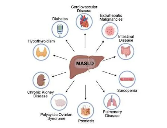 Metabolic Dysfunction-Associated Steatotic Liver Disease: Clinical Challenges In The MENA Region