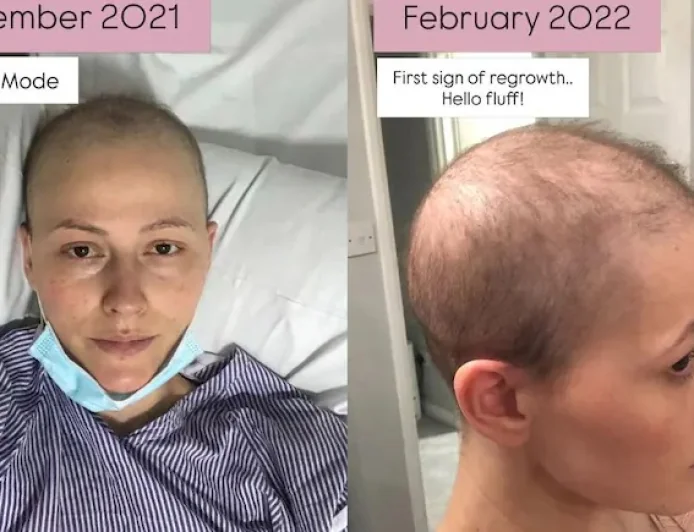 This Is What My Hair Looks Like Now': Breast Cancer Survivor Shares Honest Post-Chemotherapy Journey