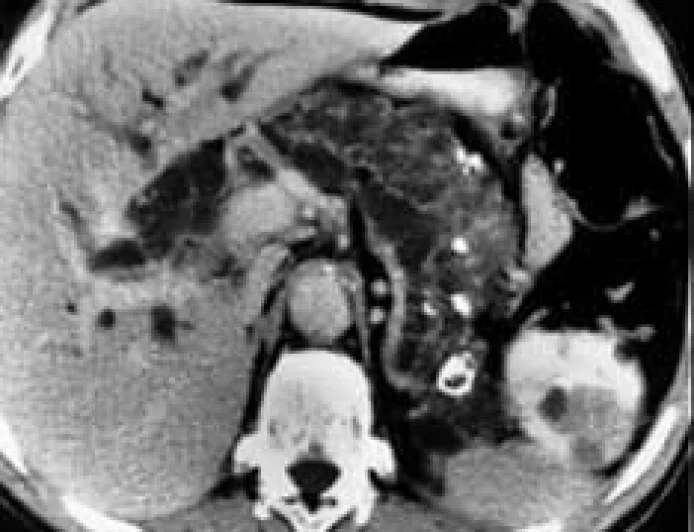Fatty Pancreas Disorder Recognised as Distinct Disease Under Melbourne Consensus