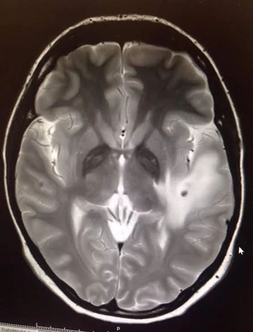 Woman Diagnosed With Metre-Long Tapeworm and 38 Brain Parasites Years After India Trip