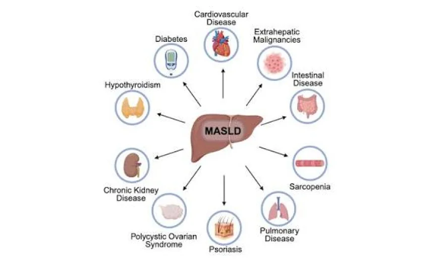 Metabolic Dysfunction-Associated Steatotic Liver Disease: Clinical Challenges In The MENA Region