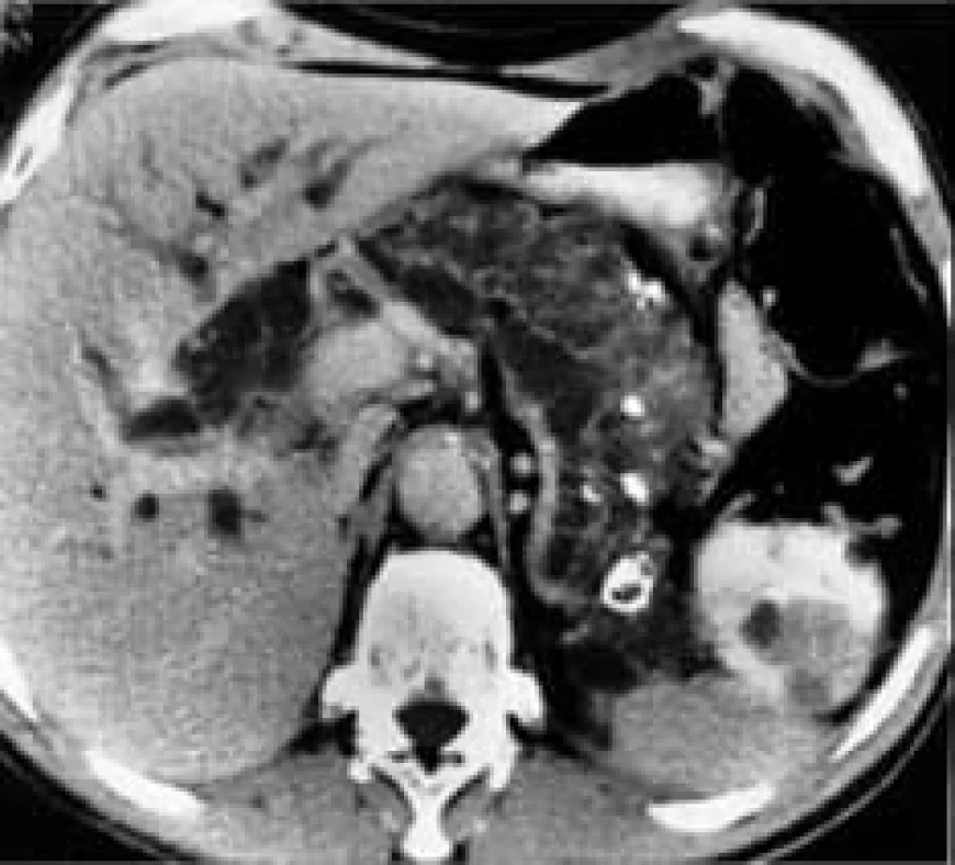 Fatty Pancreas Disorder Recognised as Distinct Disease Under Melbourne Consensus
